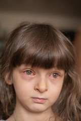 Fototapeta premium Girl with red eyes with conjunctivitis disease