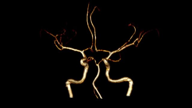 Animated 3D reconstruction from time-of-flight (TOF) MR angiography showing a horizontal axis rotation of the intracranial arterial system