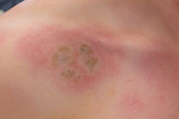 Fototapeta premium Macro Detail of Tinea Versicolor Rash with Redness