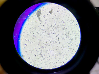 Microscopic View of Calcium Oxalate Crystals in Human Urine Sample