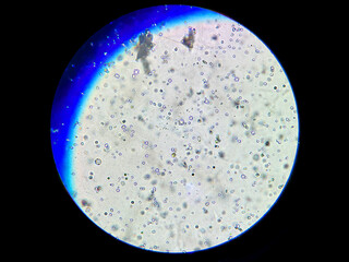 Microscopic View of Calcium Oxalate Crystals in Human Urine Sample