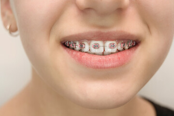 Naklejka premium Close-up of smile with braces and pink bands highlighting dental care dental health and good oral hygiene practices for achieving beautiful and aligned smile