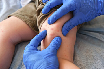 Doctor examining child with bodily red rash. Kid allergy closeup. Little baby scratches an eruption. Nurse applies special cream to atopic skin. Dermatitis, irritation, hive. Pruritus. Mosquito bites