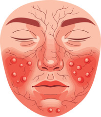 Illustration depicting a face affected by rosacea, showing redness and visible blood vessels.