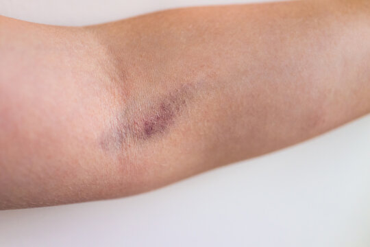 Macro closeup of female woman arms with large bruise medical condition due to blood test or vaccine showing texture of skin and blood
