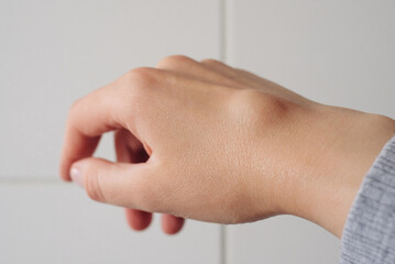Female right back hand with ganglion cyst on the dorsum,  fluid-filled bump associated with a joint...
