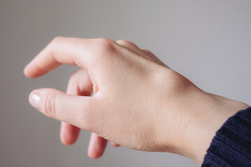Female right back hand with ganglion cyst on the dorsum,  fluid-filled bump associated with a joint or tendon sheath, close-up view, selected focus.