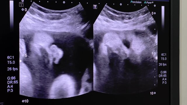 Ultrasound display of 32 weeks pregnant. Fetus ultrasound image that show important organs.