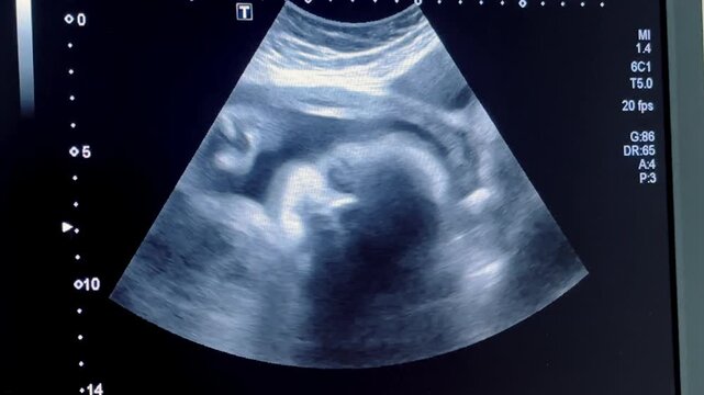 Ultrasound display of 32 weeks pregnant. Fetus ultrasound image that show important organs.