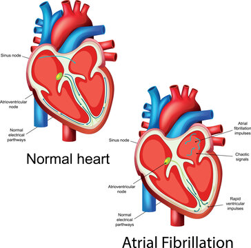 Medical illustration comparing normal heart and atrial fibrillation with heartbeat rhythm and anatomy
