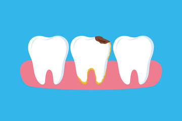 Tooth Decay Illustration: Dental Health Awareness with Caries and Gum Disease