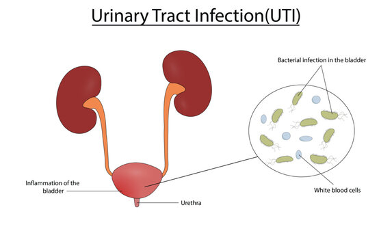 Urinary tract infection(UTI) vector illustration