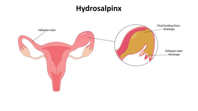 Hydrosalpinx vector illustration