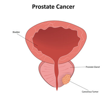 Prostate cancer vector illustration