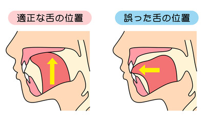 正しいミューイングの方法　適正な舌の位置と誤った舌の位置 © koti
