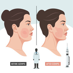 Before and After Ozempic: Weight Loss Effects on Facial Fat, Visual Demonstration of Ozempic's Facial Slimming and Weight Loss Effects