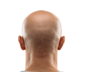 Back view of a bald mans head against a neutral background