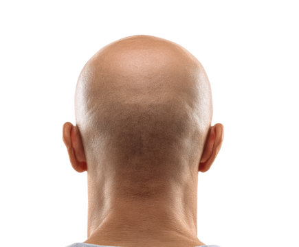 Back view of a bald mans head against a neutral background