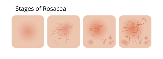 Rosacea skin condition showing different stages of its development