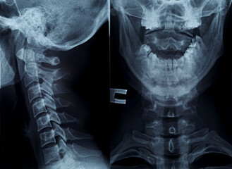 X-ray picture of the cervical spine in two projections in full view and profile. X-ray for medical diagnosis 