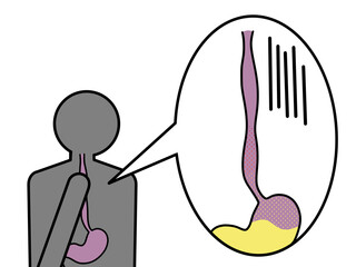 逆流性食道炎による胸焼け
