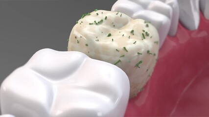 Removing plaque, where bacteria accumulates on the tooth surface, toothpaste or mouthwash cleans plaque and strengthens the tooth surface. Before and after comparison. Oral hygiene product ads, 3d.