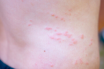 human skin covered in red, itchy rash, 11-year-old child with multiple bites and rash on body, symptoms eczema, chickenpox, allergic reaction or mosquito bites