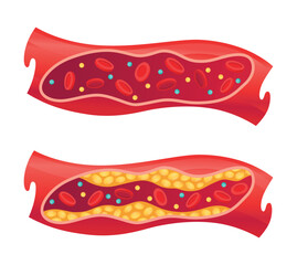 Types of cholesterol in human blood vessels. Normal and narrowed artery for explanation diseases. High-Density Lipoprotein HDL and Low-Density Lipoprotein LDL. Vector illustration