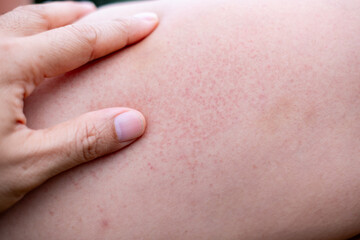 Close up of irritated human skin with red rash and inflammation, suitable for medical, dermatology, allergy, and skincare-related concepts in healthcare or pharmaceutical design.