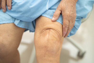 Naklejka premium Asian elderly woman patient with scar knee replacement surgery in hospital.