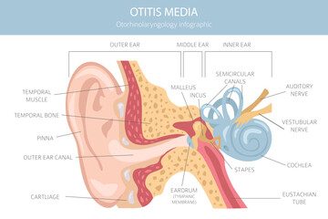Otitis media. Infection in the middle ear. Otological disorders infographic. Vector illustration