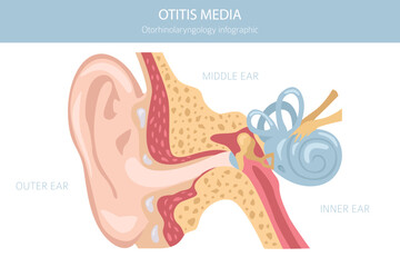 Otitis media. Infection in the middle ear. Otological disorders infographic. Vector illustration