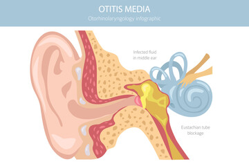 Otitis media. Infection in the middle ear. Otological disorders infographic. Vector illustration