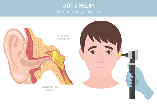 Otitis media. Infection in the middle ear. Otological disorders infographic. Vector illustration