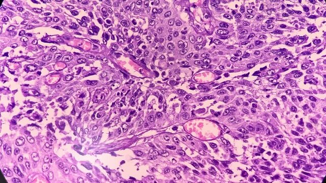 Photographic footage showing Metastatic squamous cell carcinoma of a lymph node, a type of skin cancer.