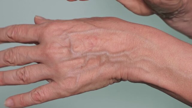 Close-up shot of the hands of a 58-year-old woman. No subcutaneous fat, thin skin through which the veins of the hands are visible. The concept of cosmetology and plastic surgery.