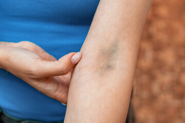 Close up of a woman gently touching a painful hematoma on her forearm, a visible reminder of the trauma from physical abuse