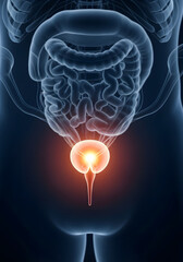 Illustration of human bladder anatomy with cancer highlighted in red color