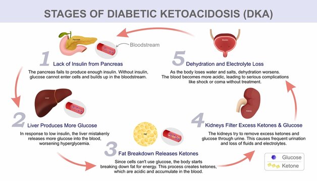 Stages of Diabetic Ketoacidosis (DKA)