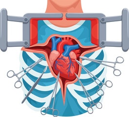 Open-heart surgery illustration with a chest retractor exposed heart and various surgical forceps.