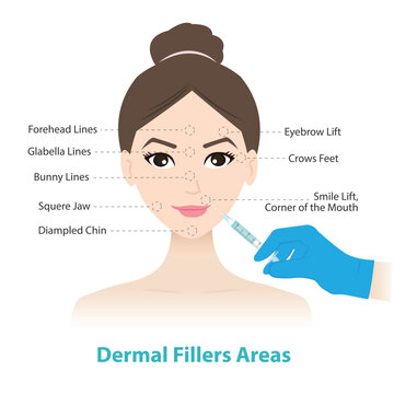 Dermal fillers treatment injection areas on woman face vector illustration. Filler inject under the skin to restore lost volume, smoothen wrinkles, enhance facial contours. Medical and beauty concept.