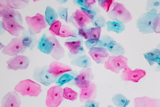 View in microscopic of normal human cervix cells.Squamous epithelial cells from pap smear cervixl and vaginal woman.Cervical cancer screening test.