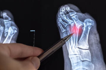 Doctor learn Medical X-ray with leg toe dislocations. Hook-shaped deformity of the finger. Lisfranc joint, Foot fractures.