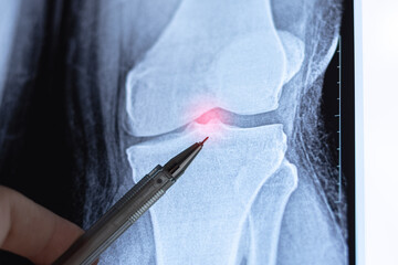 Doctor learn X-ray of Knee joint dislocation after accident. Patellar joint instability. Tibial...