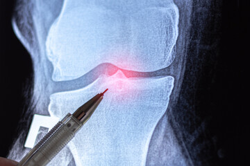 Doctor learn X-ray of Knee joint dislocation after accident. Patellar joint instability. Tibial dislocation in relation to the femur.