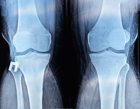 X-ray of Knee joint dislocation after accident. Patellar joint instability. Tibial dislocation in relation to the femur.