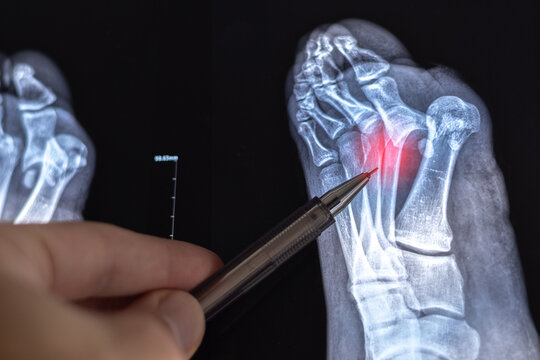 Doctor learn Medical X-ray with leg toe dislocations. Hook-shaped deformity of the finger. Lisfranc joint, Foot fractures.