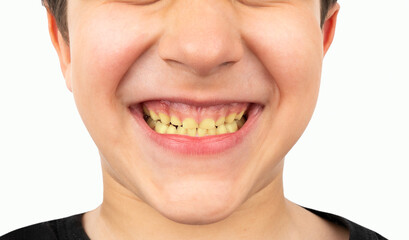 Close up portrait smile teeth child.Yellow ugly teeth from disease. Crooked dirty isolated with white background