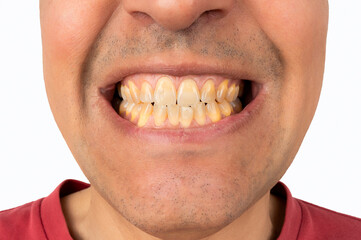 Close up portrait smile teeth man.Yellow ugly teeth from smoking, alcohol, disease. Crooked dirty isolated with white background