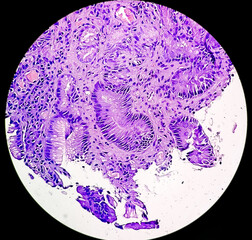 Photomicrograph of Gastric biopsy showing Grade 3 adenocarcinoma
